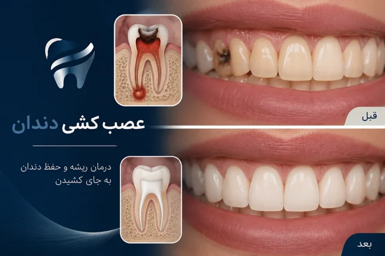 عصب کشی دندان در تهران