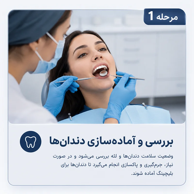 مرحله اول بلیچینگ کردن دندان ها