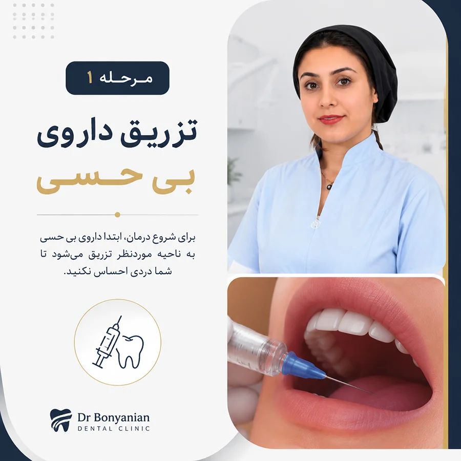 مرحله اول عصب کشی دندان