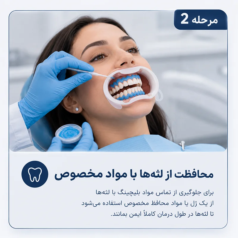 مرحله دوم بلیچینگ کردن دندان ها