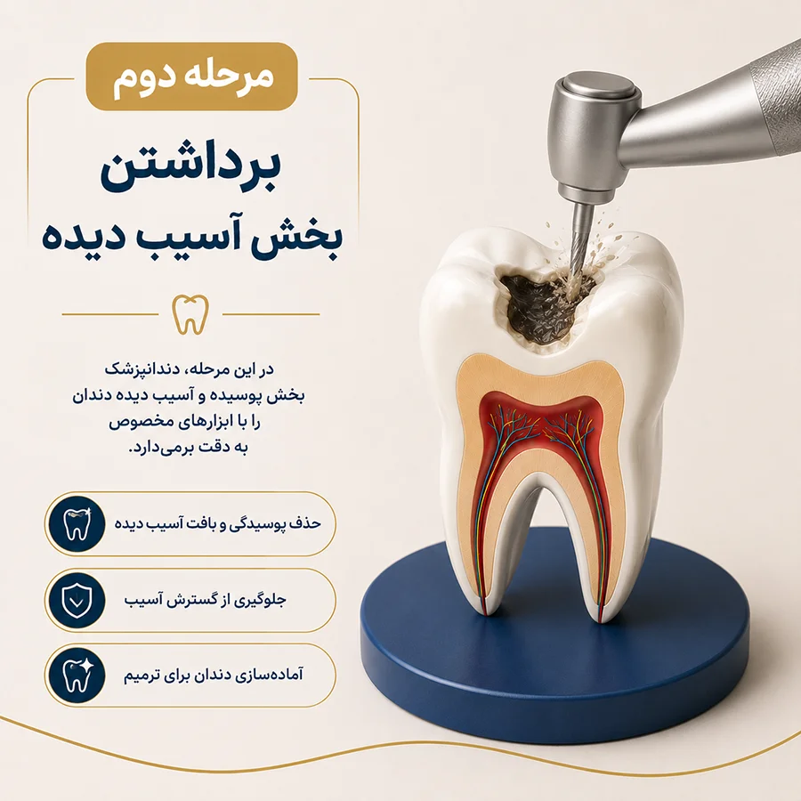 مرحله دوم ترمیم دندان