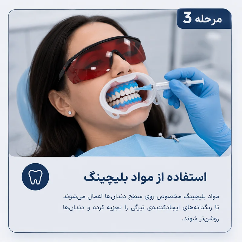 مرحله سوم بلیچینگ کردن دندان ها