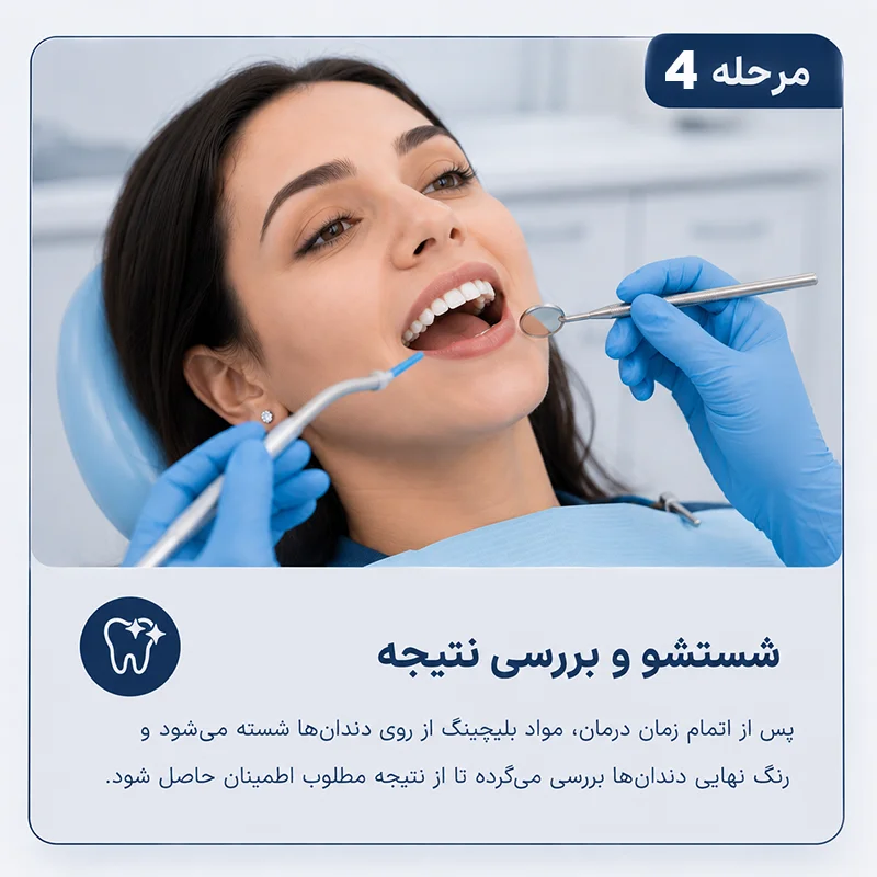 مرحله چهارم بلیچینگ کردن دندان ها