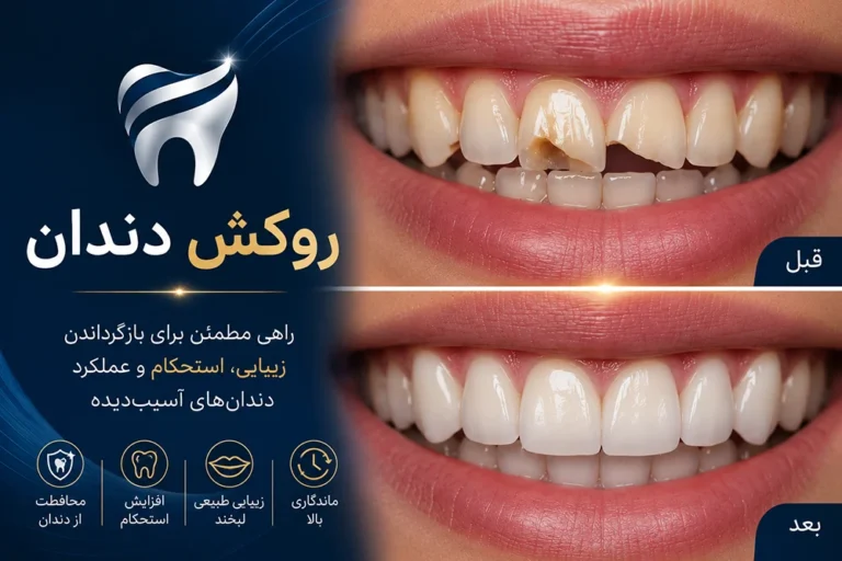 چه کسانی باید دندانشان را روکش کنند؟
