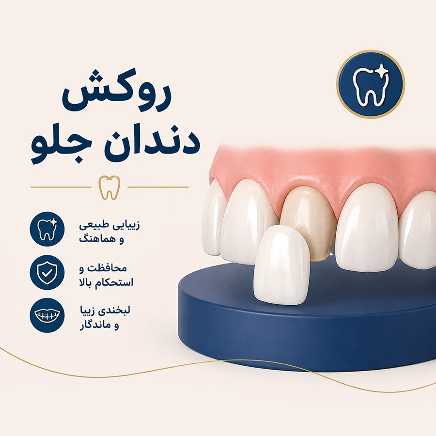 روکش دندان جلو