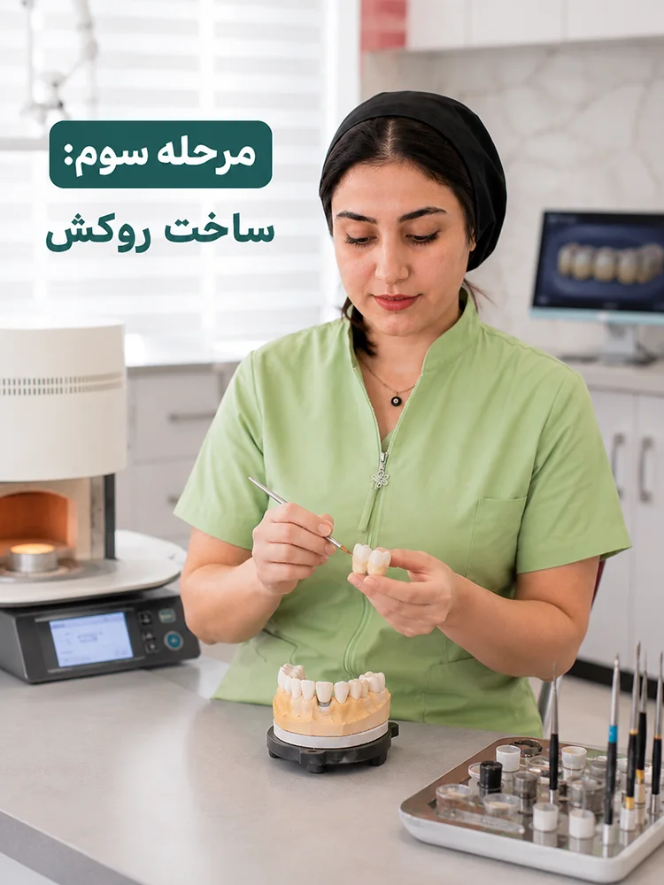 مرحله سوم ساخت روکش دندان