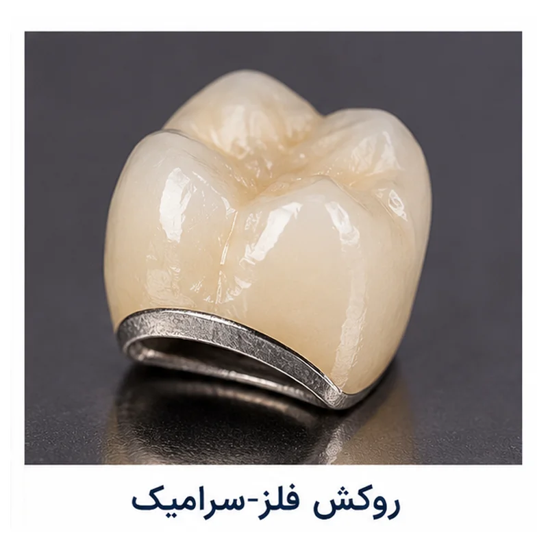 معرفی روکش فلز سرامیک