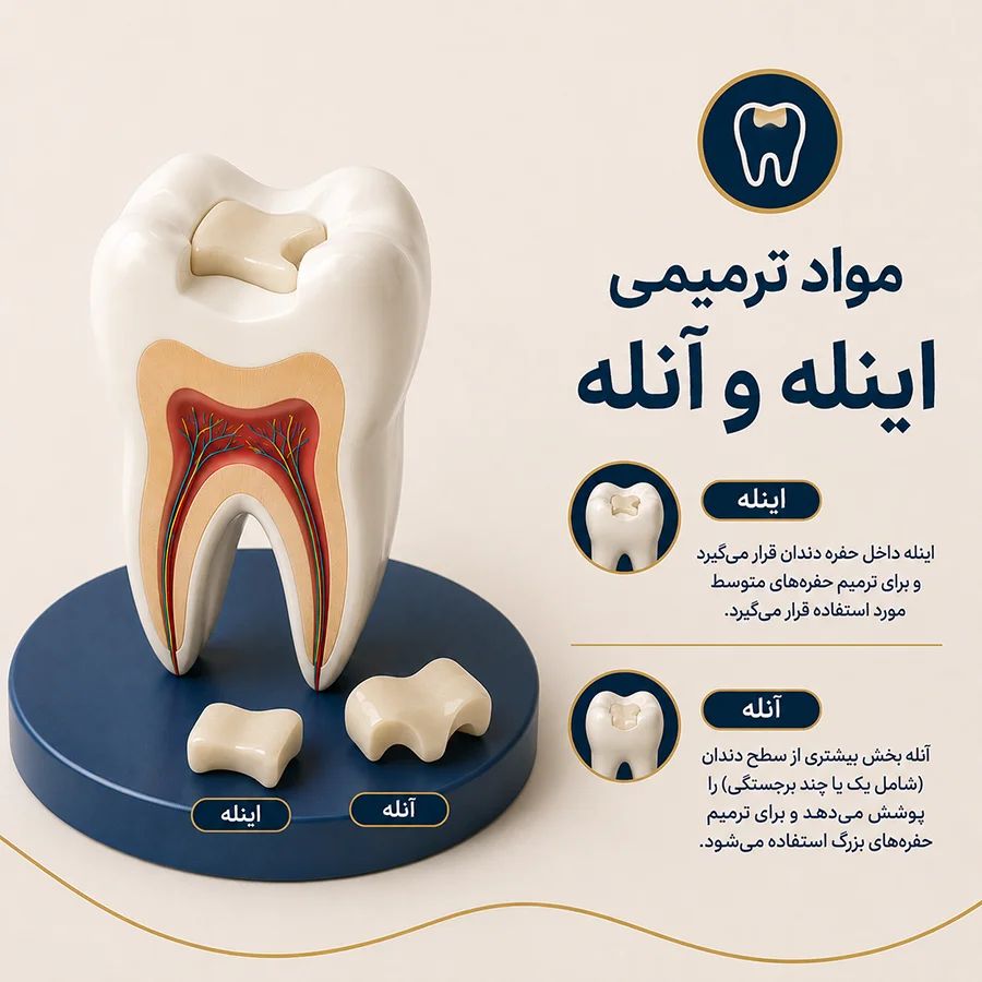 مواد ترمیمی اینله و آنله دندان