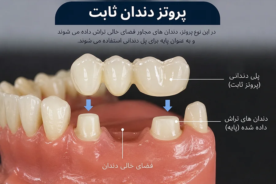 پروتز دندان ثابت